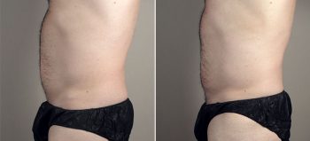 Male Liposuction Patient 27 & Gynecomastia