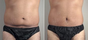 Male Mini Tummy Tuck 20