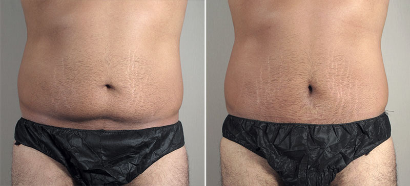 Male Mini Tummy Tuck 20