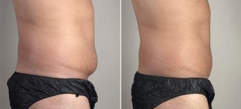 Male Mini Tummy Tuck 20