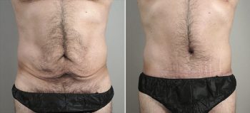 Male lipoabdominoplasty Patient 12