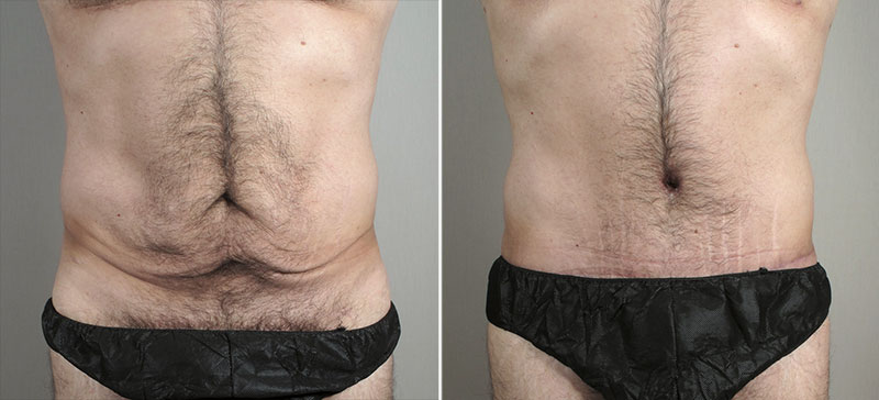 Male lipoabdominoplasty Patient 12