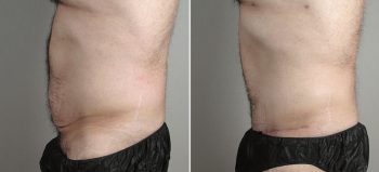 Male lipoabdominoplasty Patient 12