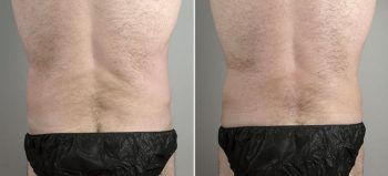 Male lipoabdominoplasty Patient 12