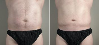 Male Liposuction Patient 27