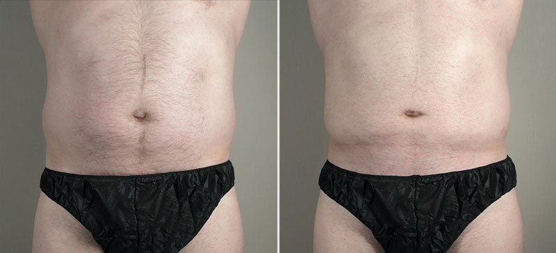 Male Liposuction Patient 27
