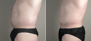 Male Liposuction Patient 27