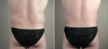Male Liposuction Patient 27
