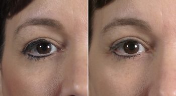 Blog Image for Parker Center Staff Get a Taste of Their Own Medicine: Parker Rejuvenation Lift