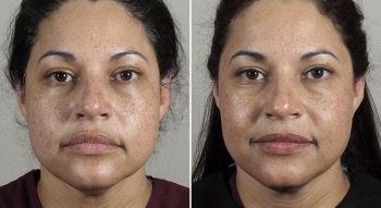 Parker Rejuvenation Lift Patient 3