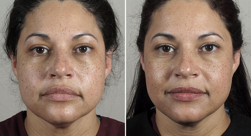 Parker Rejuvenation Lift Patient 3
