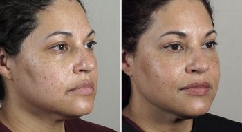 Parker Rejuvenation Lift Patient 3