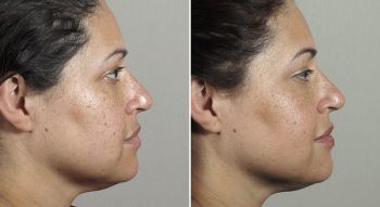 Parker Rejuvenation Lift Patient 3