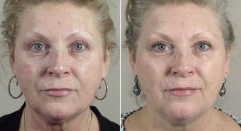 Parker Rejuvenation Lift Patient 4
