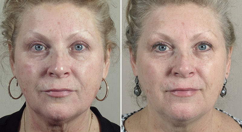 Parker Rejuvenation Lift Patient 4