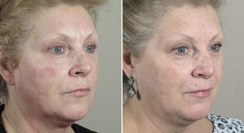 Parker Rejuvenation Lift Patient 4