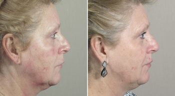 Parker Rejuvenation Lift Patient 4
