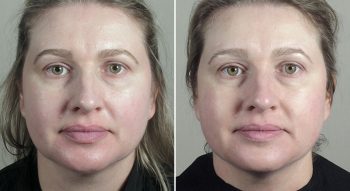 Parker Rejuvenation Lift Patient 5