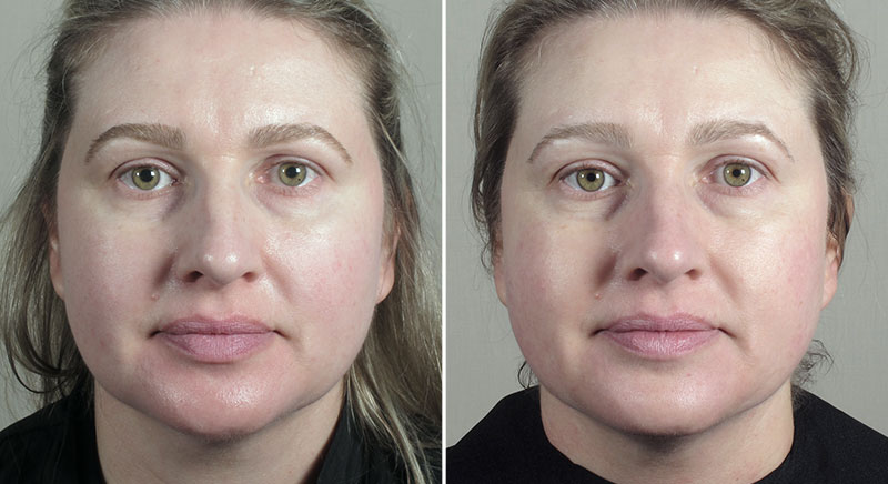 Parker Rejuvenation Lift Patient 5