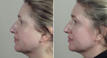 Parker Rejuvenation Lift Patient 5