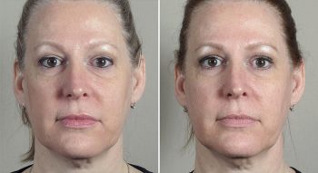 Parker Rejuvenation Lift Patient 8