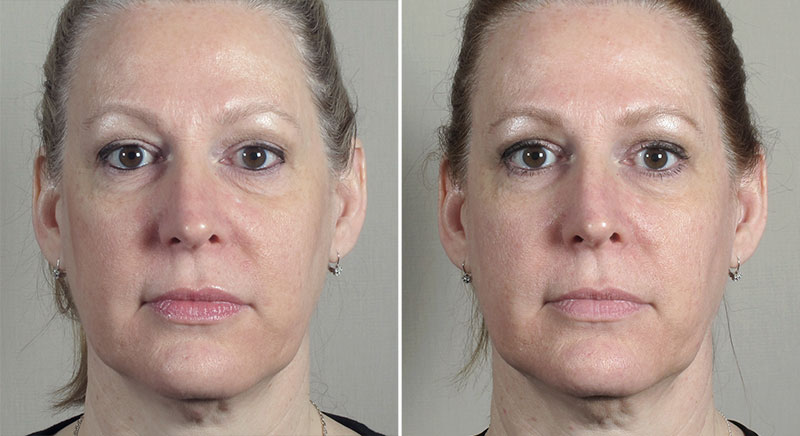 Parker Rejuvenation Lift Patient 8