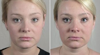 Parker Rejuvenation Lift Patient 6