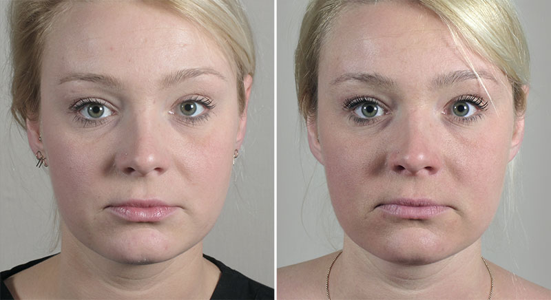 Parker Rejuvenation Lift Patient 6