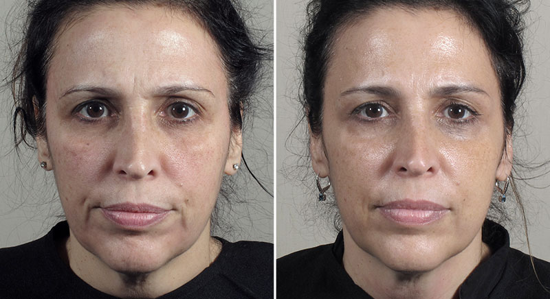 Parker Rejuvenation Lift Patient 9