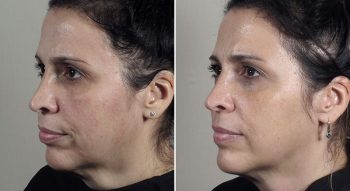 Parker Rejuvenation Lift Patient 9