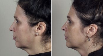 Parker Rejuvenation Lift Patient 9