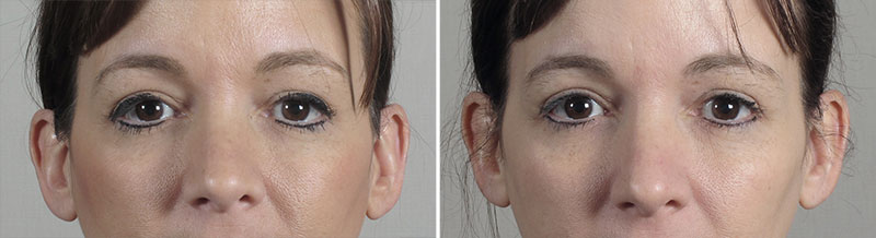 Parker Rejuvenation Lift Patient 7