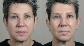 Parker Rejuvenation Lift Patient 10