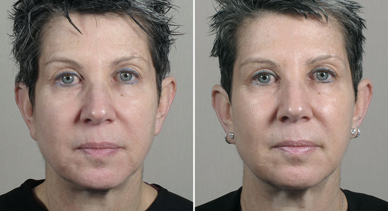 Parker Rejuvenation Lift Patient 10