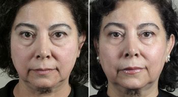 Parker Rejuvenation Lift Patient 2