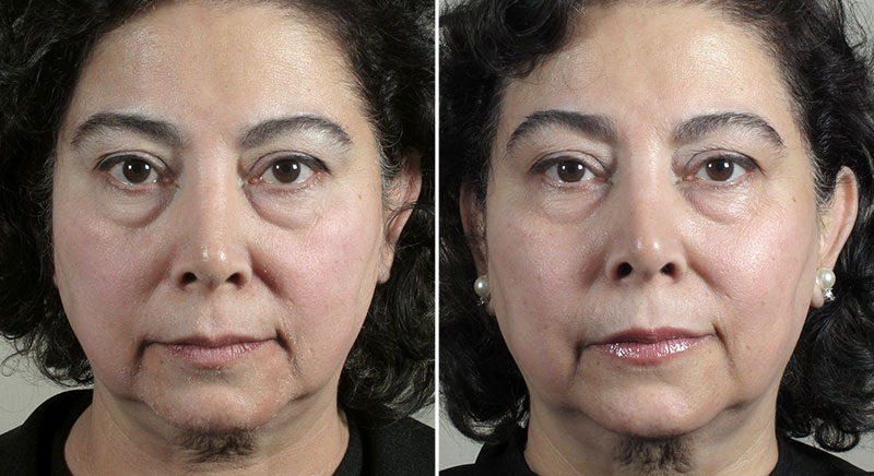 Parker Rejuvenation Lift Patient 2