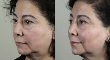Parker Rejuvenation Lift Patient 2
