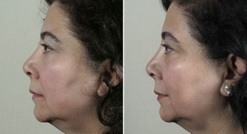 Parker Rejuvenation Lift Patient 2