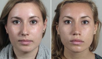 Rhinoplasty Patient 66