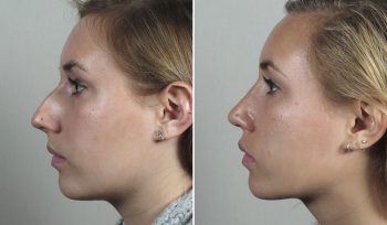 Rhinoplasty Patient 66