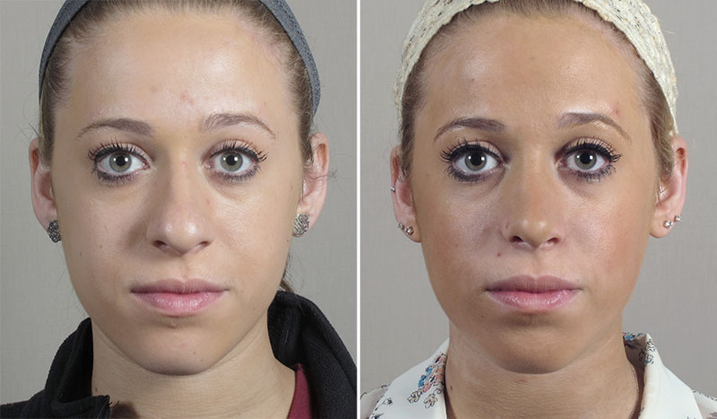 Rhinoplasty Patient 67