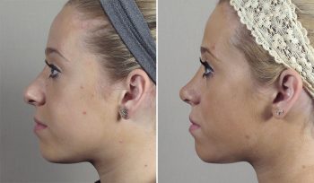 Rhinoplasty Patient 67