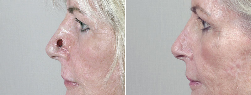 Skin Cancer Treatment Patient 54