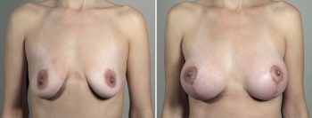 Breast Lift with Implants Patient 46