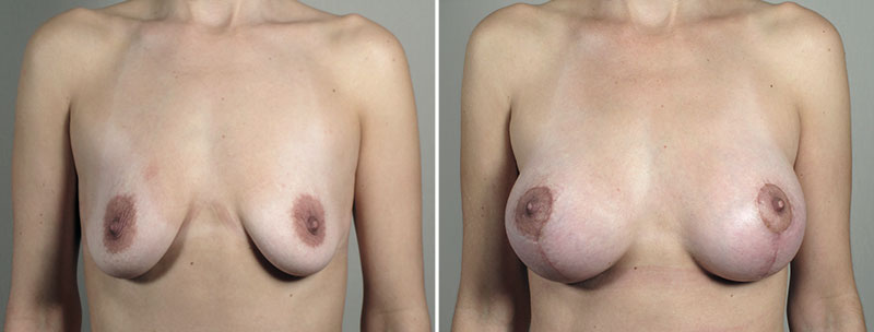 Breast Lift with Implants Patient 46