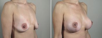 Breast Lift with Implants Patient 46