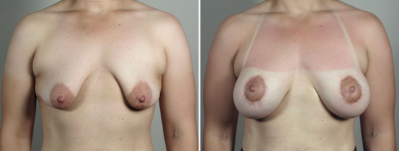 Breast Lift with Implants Patient 47