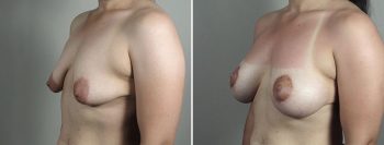 Breast Lift with Implants Patient 47