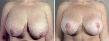 Breast Lift (Vertical Mastopexy) Patient 17