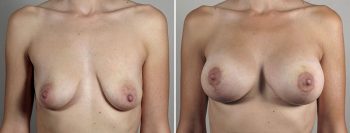 Breast Lift with Implants Patient 48